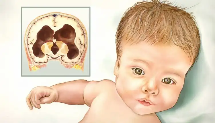 Tempat Pengobatan Hidrocephalus di Jakarta Tanpa Obat Kimia dan Operasi