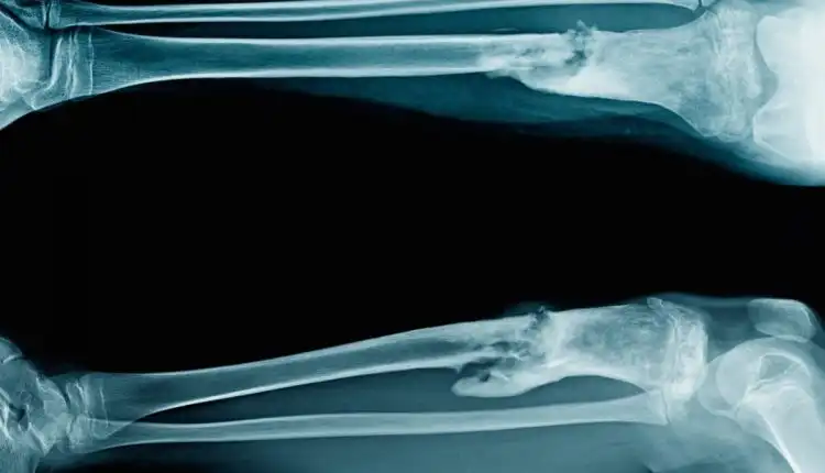 Tempat Pengobatan Osteomielitis atau Infeksi Tulang di Jakarta Terpercaya