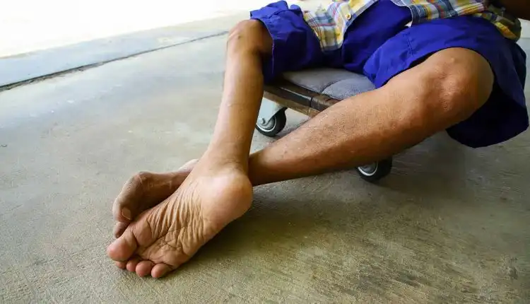 Tempat Pengobatan Polio di Jakarta Paling Dicari Banyak Orang