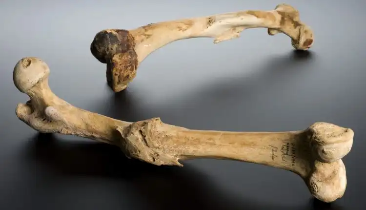 Tempat Pengobatan Osteomielitis atau Infeksi Tulang di Depok Tanpa Operasi