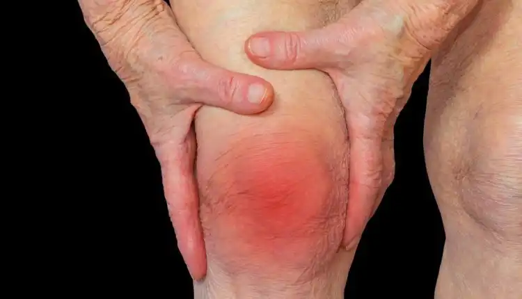 Tempat Pengobatan Rematik atau Rheumatoid Arthritis (RA) di Depok Paling Ahli