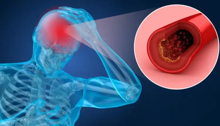 Tempat Pengobatan Stroke di Jakarta Profesional Paling Direkomendasikan