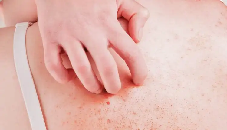 Tempat Pengobatan Autoimun di Depok Paling Direkomendasikan