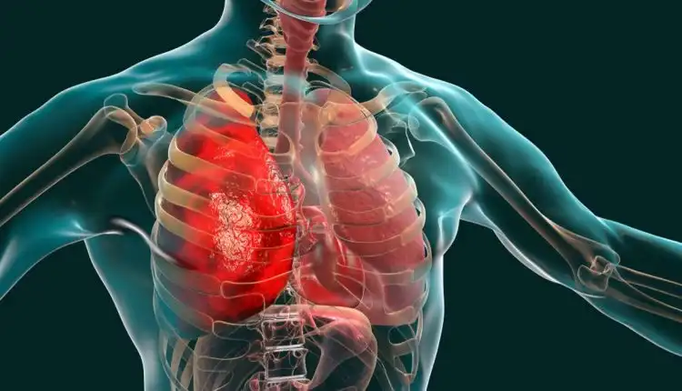 Tempat Pengobatan Pneumonia di Depok Terbaik dan Nyaman