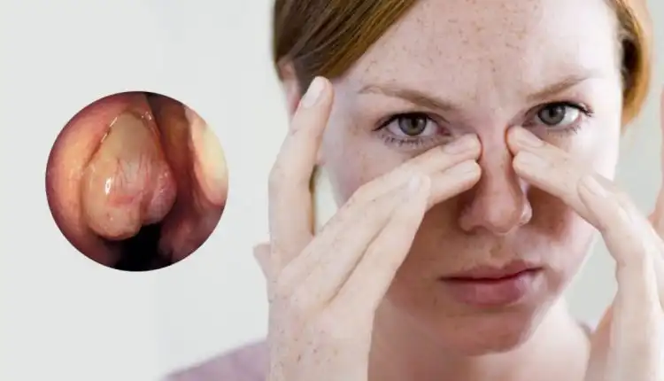 Tempat Pengobatan Polip di Depok Terbaik dan Tanpa Operasi