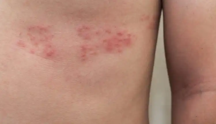 Tempat Pengobatan Herpes Zoster di Tangerang Terbaik dan Paling Aman