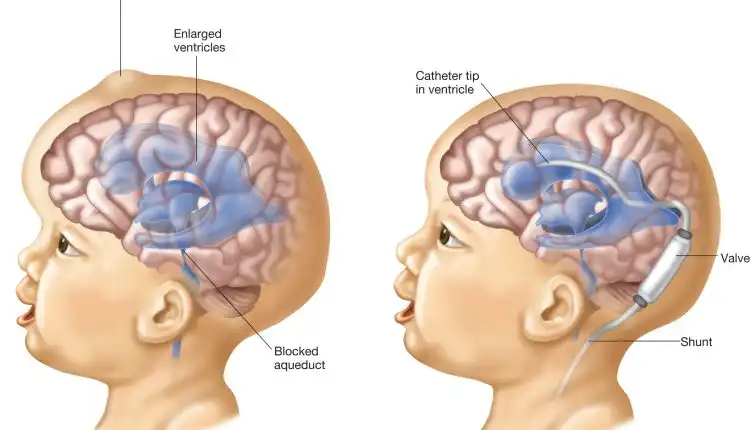 Tempat Pengobatan Hidrocephalus di Tangerang Paling Aman dan Nyaman