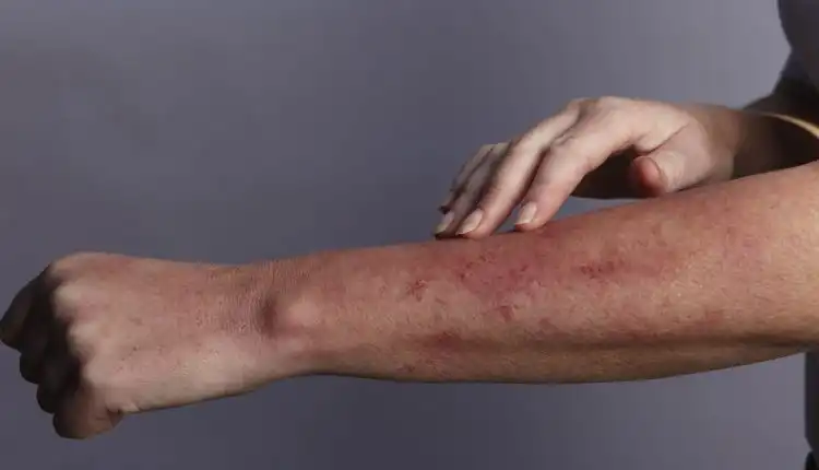 Tempat Pengobatan Lupus di Tangerang dan Palembang Terpopuler