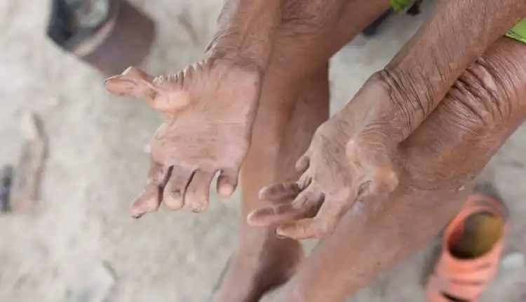 Tempat Pengobatan Polio di Tangerang Terbaik dan Paling Nyaman