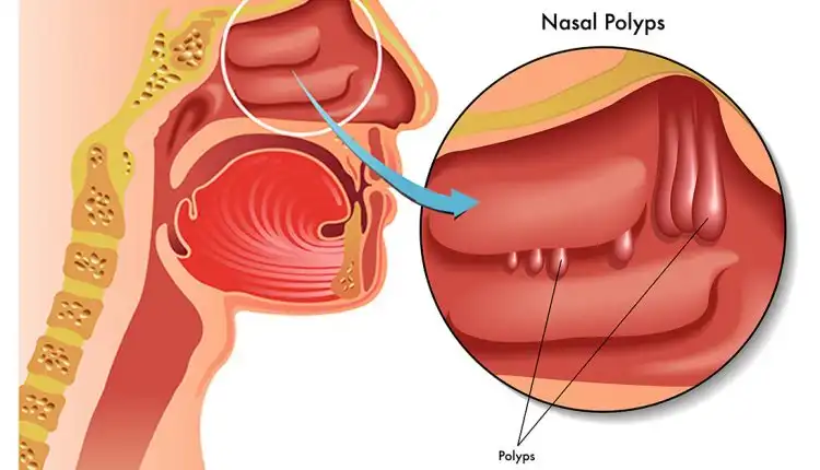 Tempat Pengobatan Polip di Tangerang dan Palembang Paling Aman dan Nyaman