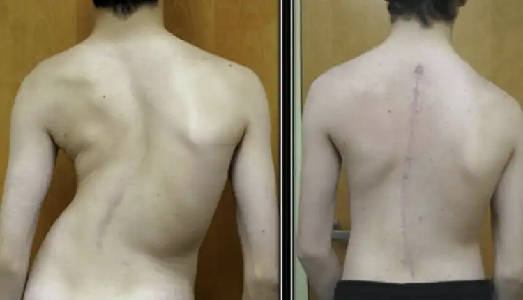 Tempat Pengobatan Skoliosis di Tangerang dan Palembang Profesional