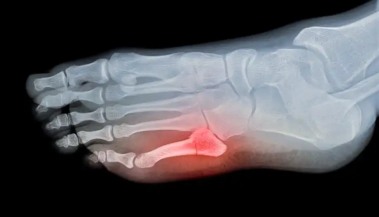 Terapi Tulang Retak di Tangerang dan Palembang Paling Aman dan Nyaman