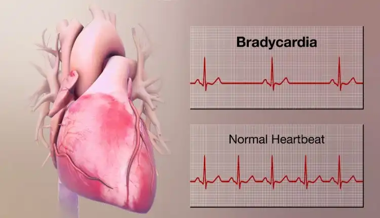 Tempat Pengobatan Bradikardia di Pekanbaru dan Bekasi Alternatif Terpopuler