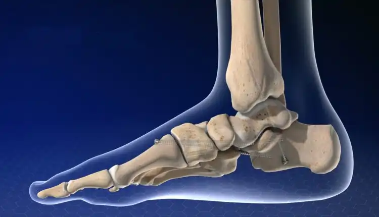 Tempat Pengobatan Charcot Joint atau Sendi Charcot di Pekanbaru dan Bekasi Terbaik