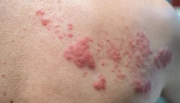 Tempat Pengobatan Herpes Zoster di Pekanbaru dan Bekasi Tanpa Obat-Obatan Kimia