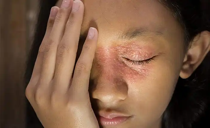 Tempat Pengobatan Lupus di Pekanbaru dan Bekasi Alternatif yang Nyaman