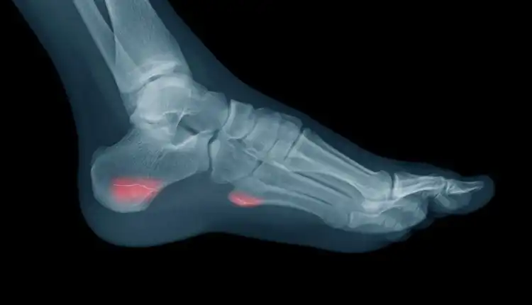 Terapi Tulang Retak di Pekanbaru dan Bekasi Profesional Tanpa Operasi