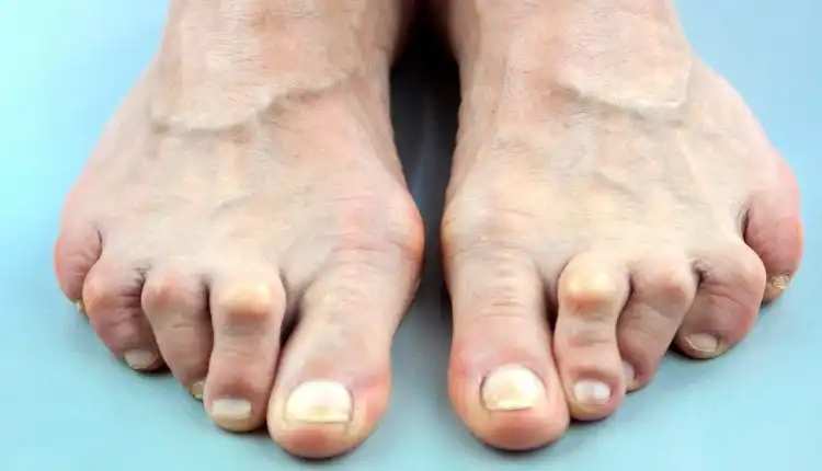 Tempat Pengobatan Charcot Joint atau Sendi Charcot di Bintaro Terbaik