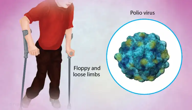 Tempat Pengobatan Polio di Bintaro dengan Metode Penyembuhan Terbaik