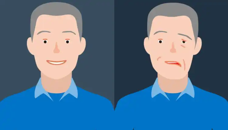 Tempat Pengobatan Virus Belpasi atau Bell's Palsy di Bintaro Terpercaya