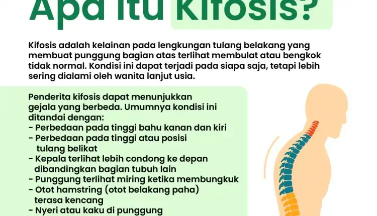 Apakah Itu Kifosis? Apakah Kifosis Berbahaya? Bagaimana Gejalanya? Hati-hati tulang belakang Bungkuk (kifosis) penyebab osteoporosis. Rumah Terapi Medical Hacking Spesialis Penyakit Skoliosis, osteoporosis dan penyakit menahun lainnya