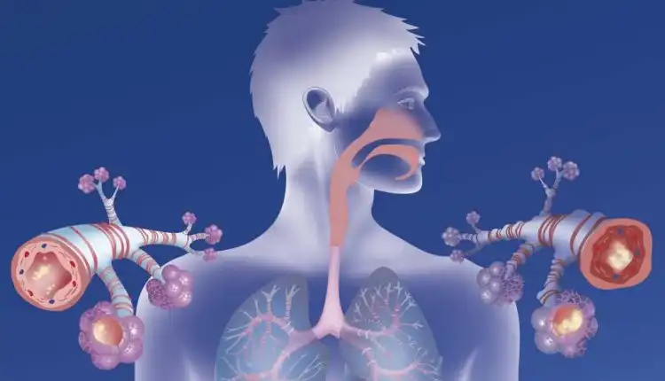 Tempat Pengobatan Asma di Bintaro Paling Populer