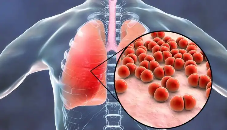 Tempat Pengobatan Pneumonia di Bintaro Paling Ampuh