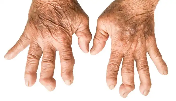 Seberapa Jauh Anda Tahu tentang Rheumatoid Arthritis (RA) atau Rematik?