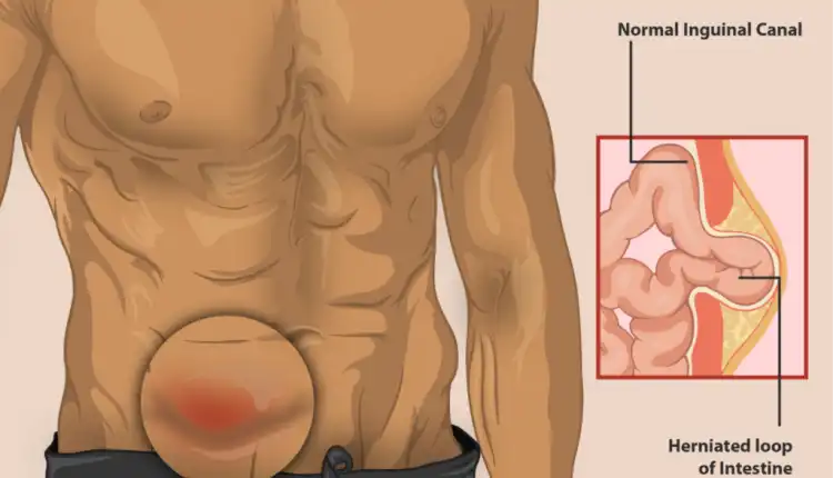 Tempat Pengobatan Hernia di Bintaro Tanpa Obat