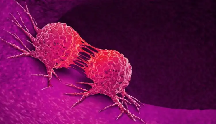 Tempat Pengobatan Kanker di Bintaro Paling Dicari