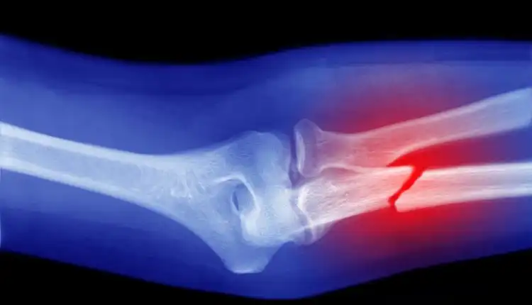 Terapi Patah Tulang di Bintaro yang Cepat Sembuh