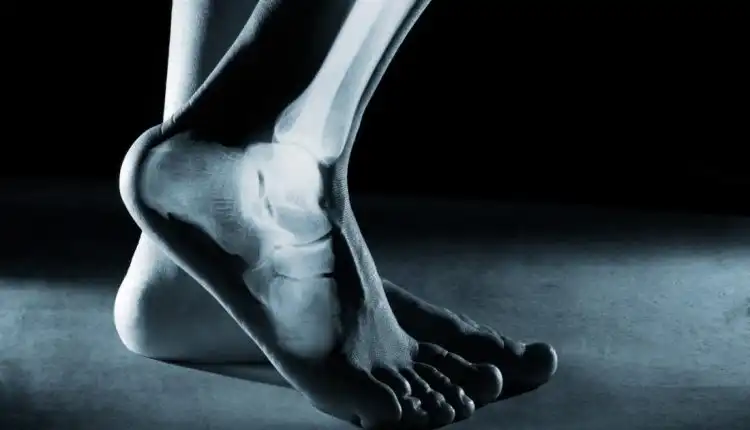 Terapi Tulang Retak di Bintaro Tanpa Operasi