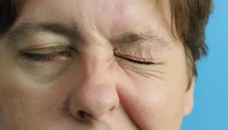 Kenali Berbagai Penyebab dan Gejala Bell’s Palsy