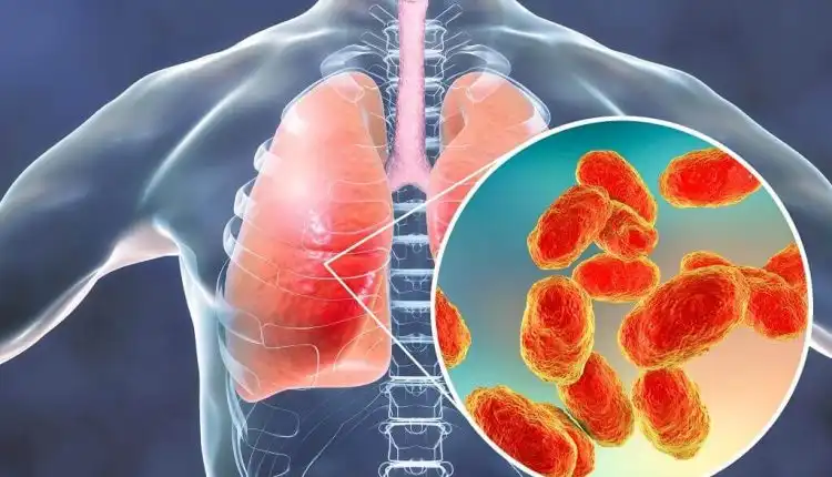 Pemahaman yang Salah tentang Pneumonia