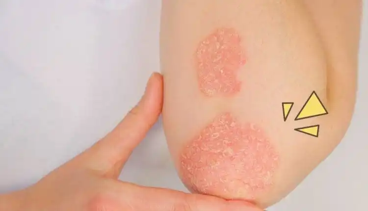 Tempat Pengobatan Autoimun di Cikarang Tanpa Obat dan Operasi