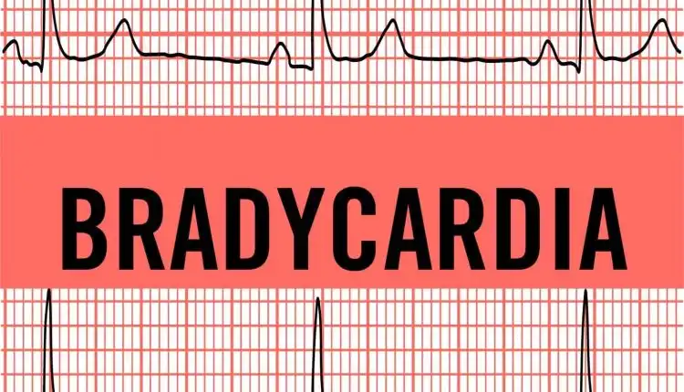 Tempat Pengobatan Bradikardia di Cibitung Paling Populer dan Direkomendasikan