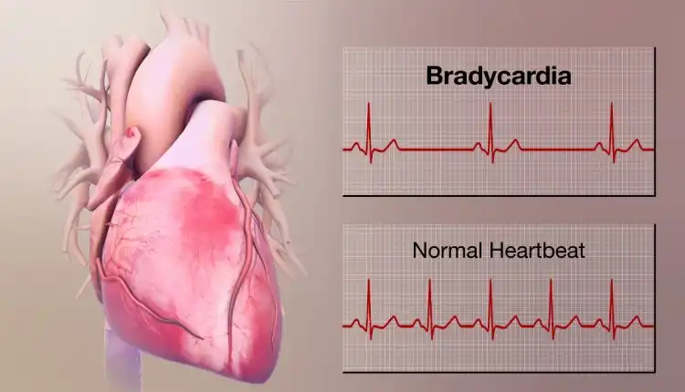 Tempat Pengobatan Bradikardia di Cikarang Terbaik dan Mujarab