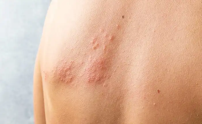 Tempat Pengobatan Herpes Zoster di Cikarang Tanpa Obat Kimia