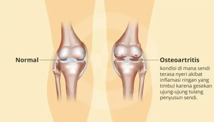 Tempat Pengobatan Osteoartritis (OA) di Cibitung Profesional dan Mujarab