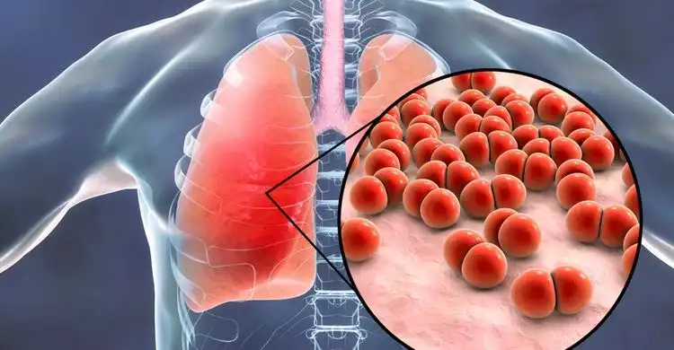 Tempat Pengobatan Pneumonia di Cibitung yang Cepat Sembuh