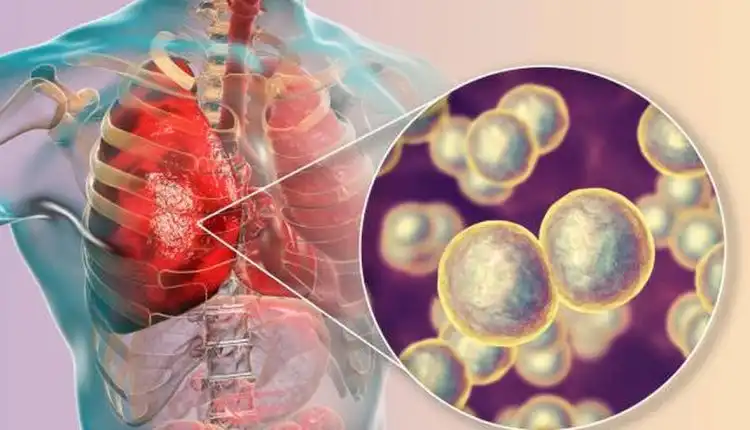 Tempat Pengobatan Pneumonia di Cikarang Tanpa Efek Samping