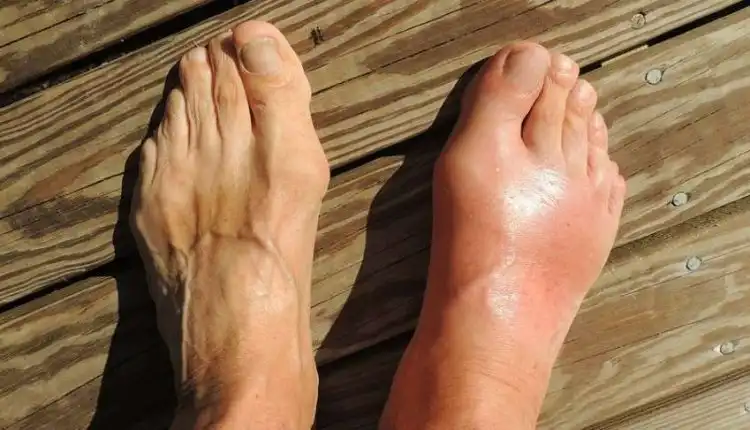 Tempat Pengobatan Rematik atau Rheumatoid Arthritis (RA) di Cibitung Terbaik