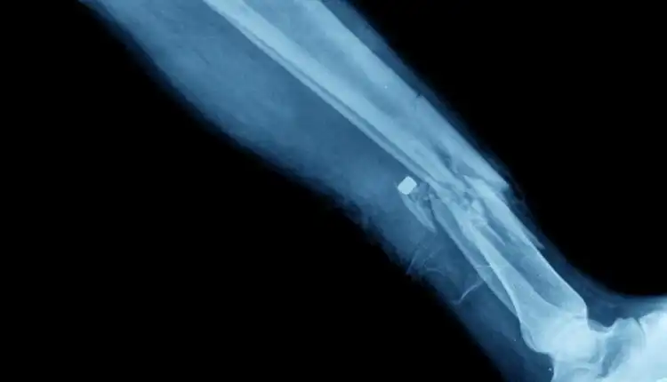 Terapi Patah Tulang di Cikarang Tanpa Operasi dan Cepat Sembuh