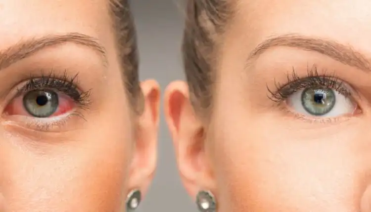 Tempat Pengobatan Glaukoma di Cibitung Paling Nyaman Tanpa Operasi