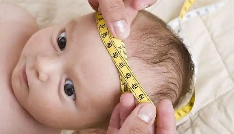 Tempat Pengobatan Hidrocephalus di Cibitung Tanpa Operasi