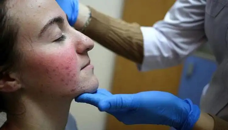 Tempat Pengobatan Lupus di Cibitung Paling Aman dan Tanpa Obat Kimia