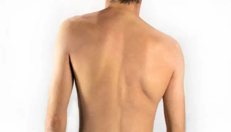 Tempat Pengobatan Skoliosis di Cibitung Tanpa Operasi dan Aman