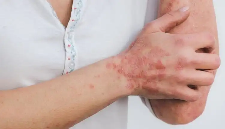 Tempat Pengobatan Autoimun di Bangkinang Tanpa Obat dan Efek Samping