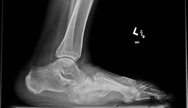 Tempat Pengobatan Charcot Joint Atau Sendi Charcot di Bangkinang Paling Aman