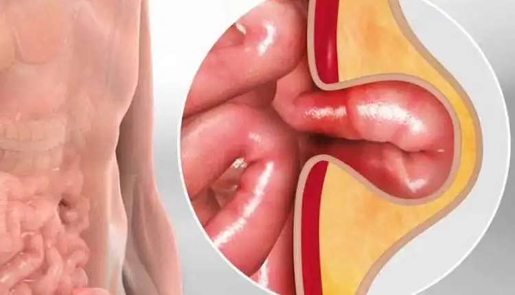 Tempat Pengobatan Hernia di Bangkinang Profesional Terpercaya